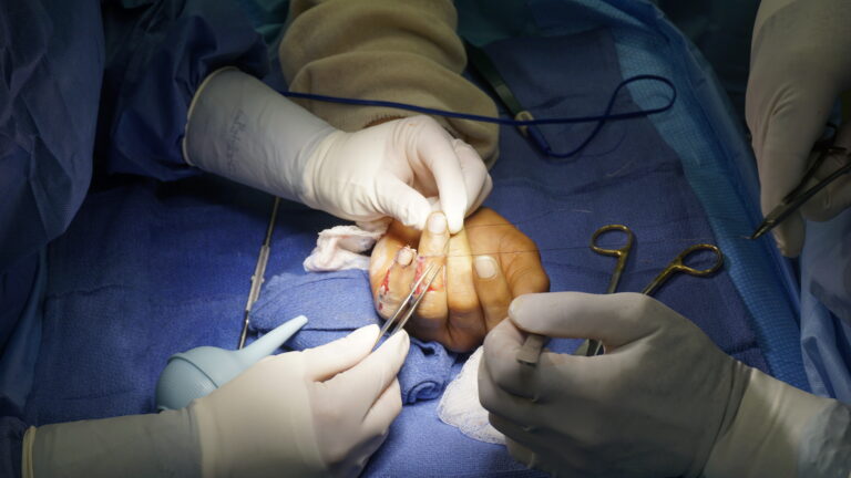 Dr. Badia cross finger flap on patient from trinidad