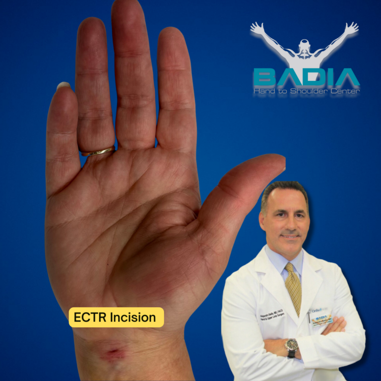 Endoscopic Carpal Tunnel Release