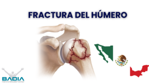 Fractura del húmero mexico