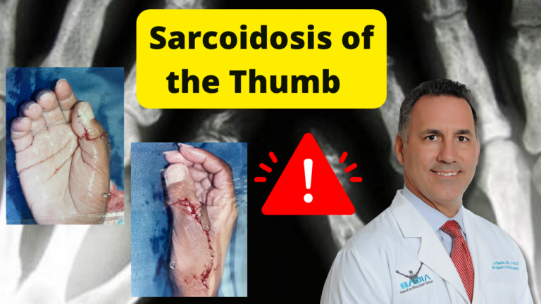 Sarcoidosis of the thumb Dr. Badia