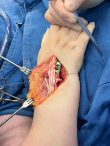 intraop distal radius fracture management with medartis plate