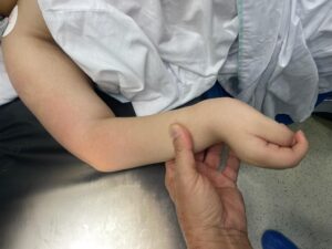 patient from ecuador before surgery with Dr. Badia