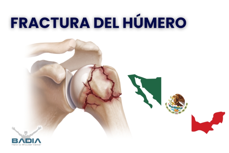Testimonio Mexico: Fractura Del Húmero
