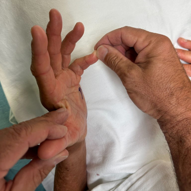 Dupuytren's contracture