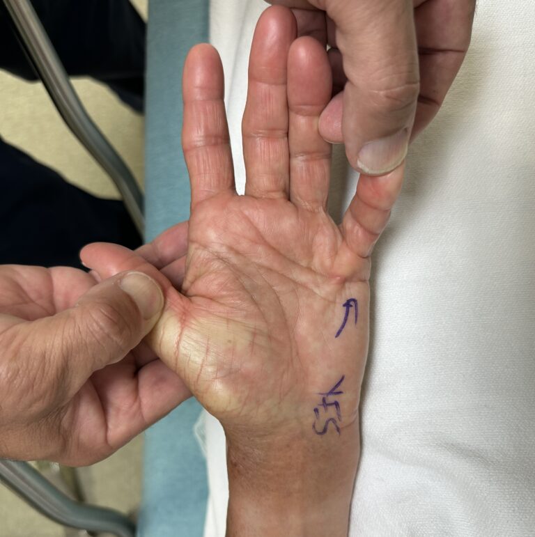 AP Dupuytren's contracture
