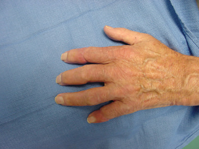 Finger Reattachment Surgery Of Amputation Of Four Fingers With A Circular Saw 1