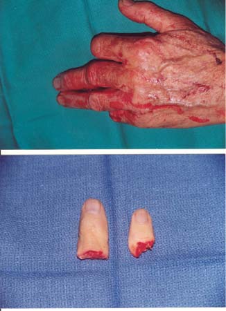Finger Reattachment Surgery Of Amputation Of Four Fingers With A Circular Saw 4