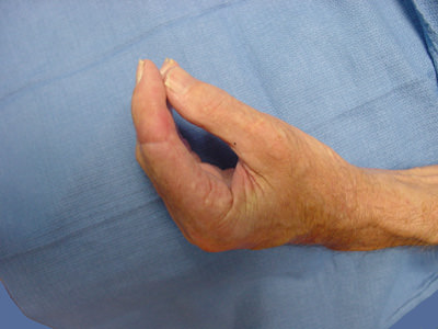 Finger Reattachment Surgery Of Amputation Of Four Fingers With A Circular Saw 7 pinch