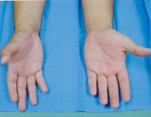 Hand And Wrist Mutilation Due To Truck Tire Explosion post op 1