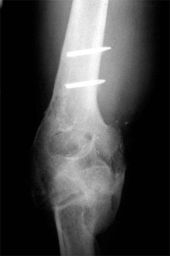 motorcycle injury Heterotopic-Ossification 5