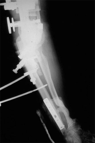 motorcycle injury Heterotopic-Ossification 4