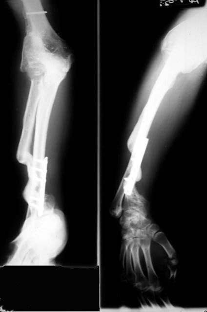 motorcycle injury Heterotopic-Ossification 3