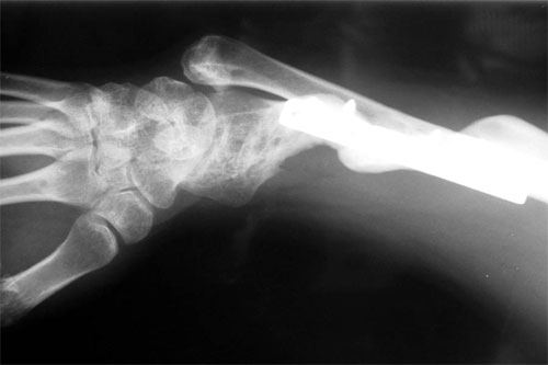 motorcycle injury Heterotopic-Ossification 2