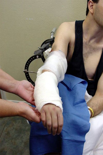 motorcycle injury Heterotopic-Ossification 1