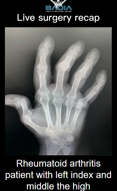 Rheumatoid Arthritis Patient Traveled From The Dominican Rep. To Regain Function In Her Fingers!