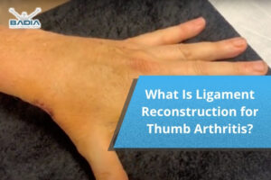 What Is Ligament Reconstruction for Thumb Arthritis?