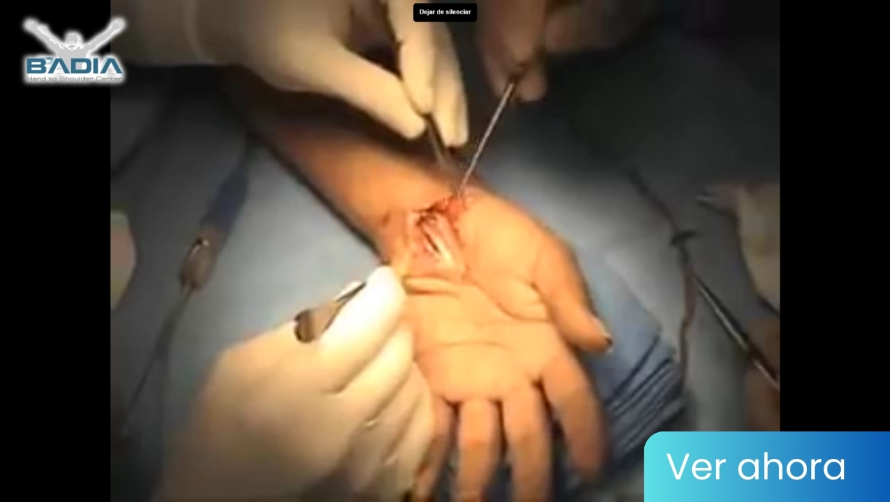 Cirugía del Tunel Carpiano Carpal Syndrome Treatment – Hypothenar Fat Flap Dr. Alejandro Badia