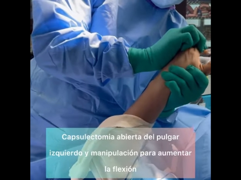 Paciente tiene rigidez en el pulgar y logra mover despues de una capsulectomia
