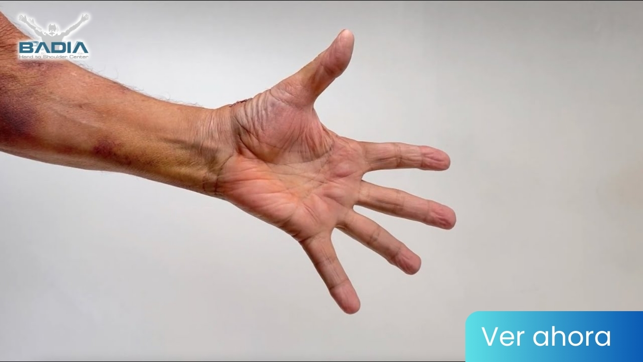 Una semana después de la cirugía de pulgar con el BioPro Modular Thumb