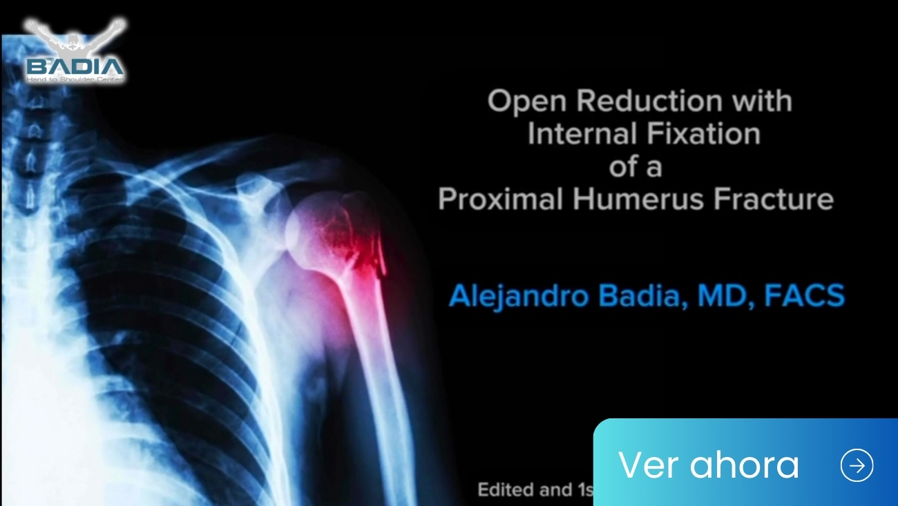 Dr Badia Performs an Open Reduction with Internal Fixation of a Proximal Humerus Fracture