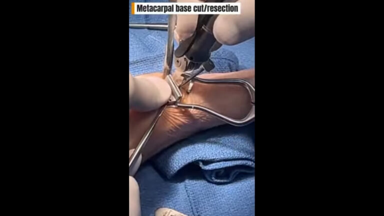 Cirugía Doble de Mano: Reemplazo Articular del Pulgar y Fusión de Dedo