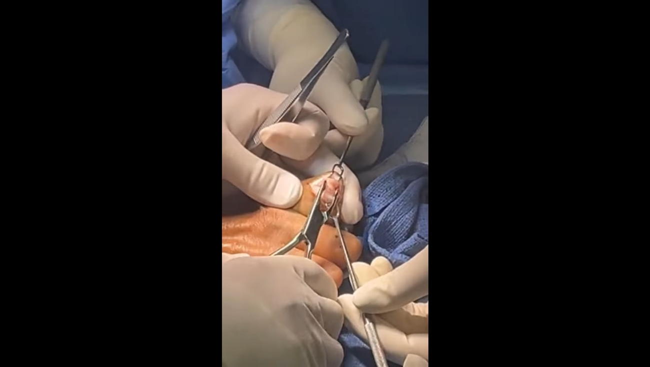 Cirugía LST para Deformidad de Mano en Garra: Corrección de Parálisis del Nervio Cubital