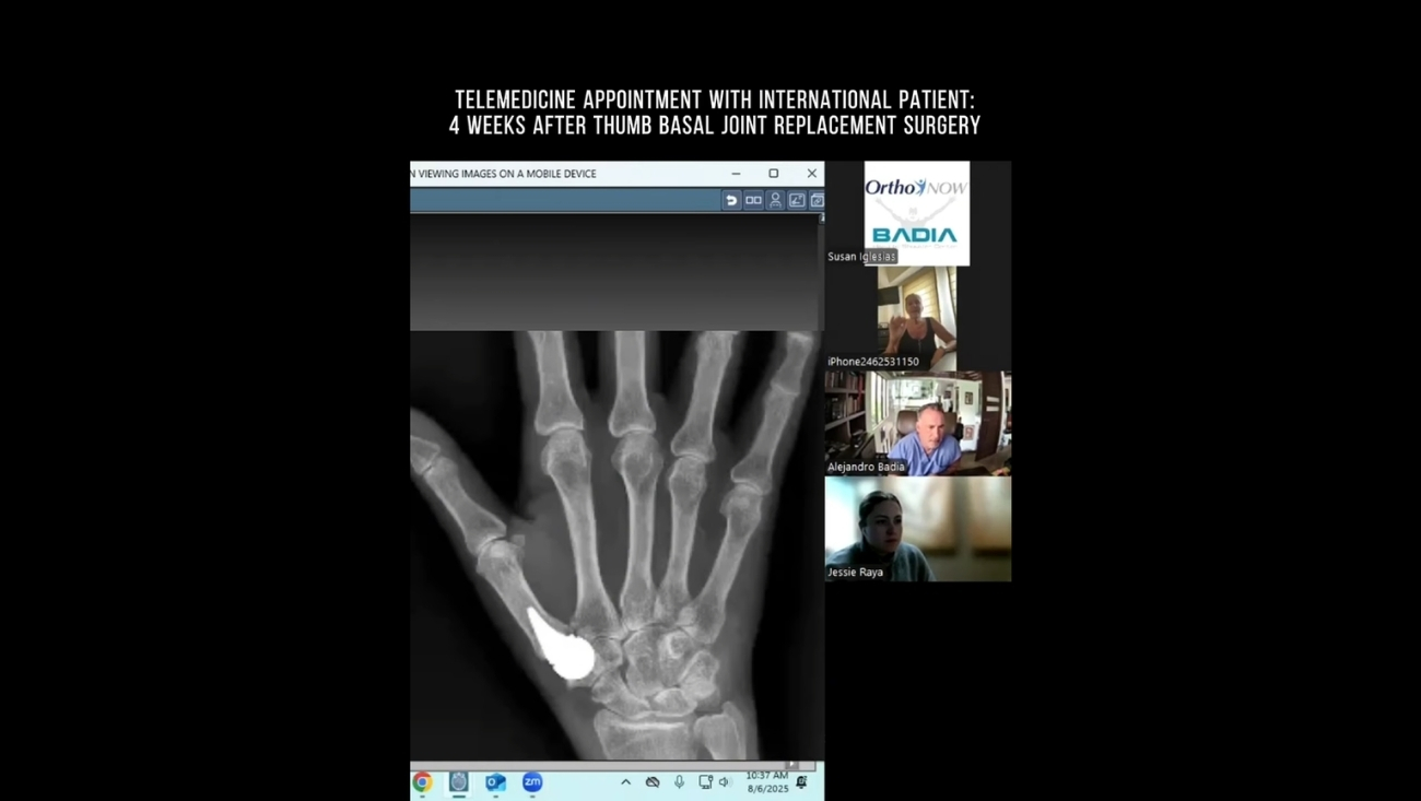 ¿Pulgar Biónico? Recuperación a las 4 Semanas de Reemplazo de Articulación Basal