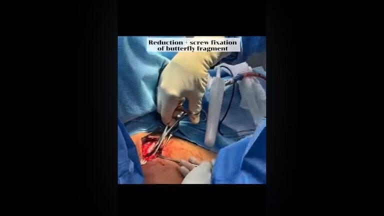 Cirugía RAFI de clavícula Fijación avanzada de fracturas del tercio medio