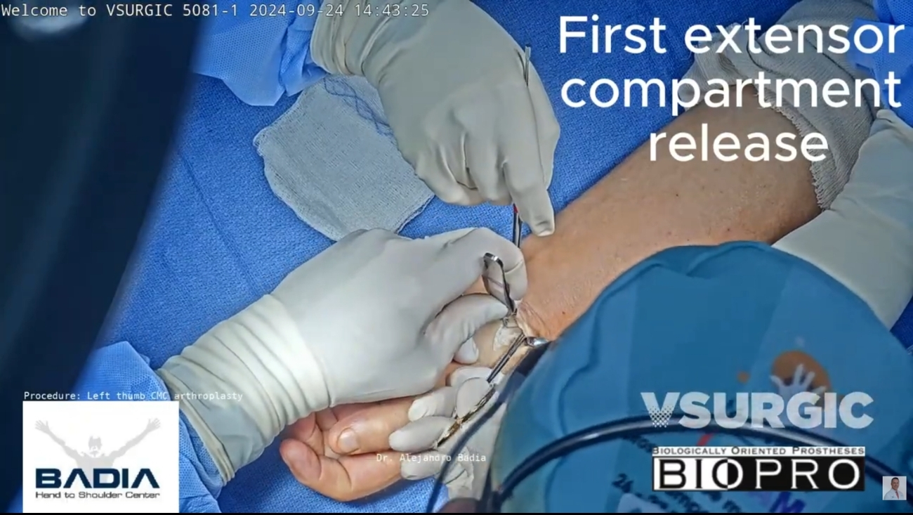 Cirugía de reemplazo de la articulación basal del pulgar (Artroplastia CMC)