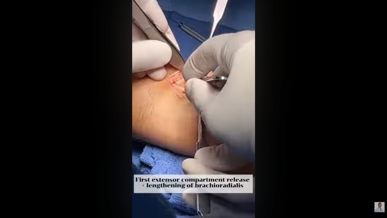 Cirugía RAFI para fractura de radio distal: Reconstrucción precisa de muñeca