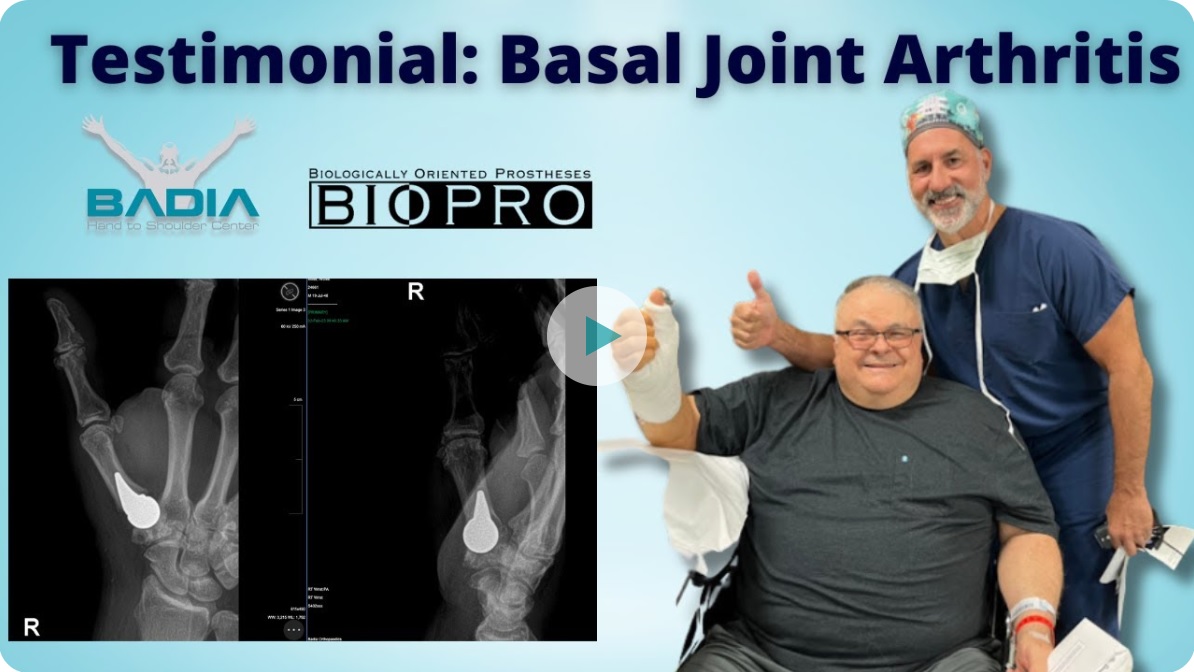 “He tenido muy poco dolor, casi ningún dolor” – Paciente tan solo 48 horas después de una hemiartroplastia de la articulación basal