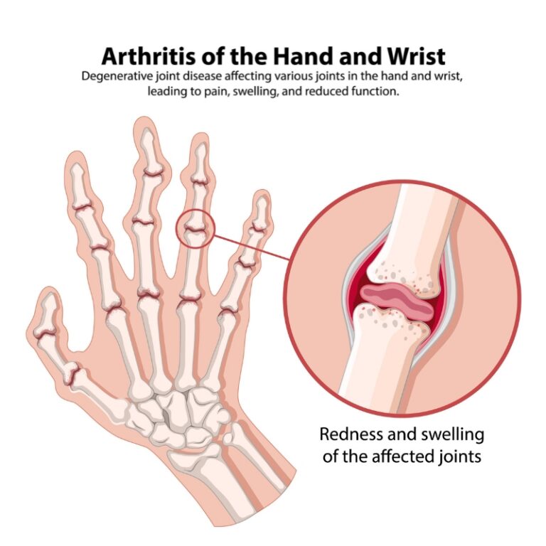 Artritis reumatoide