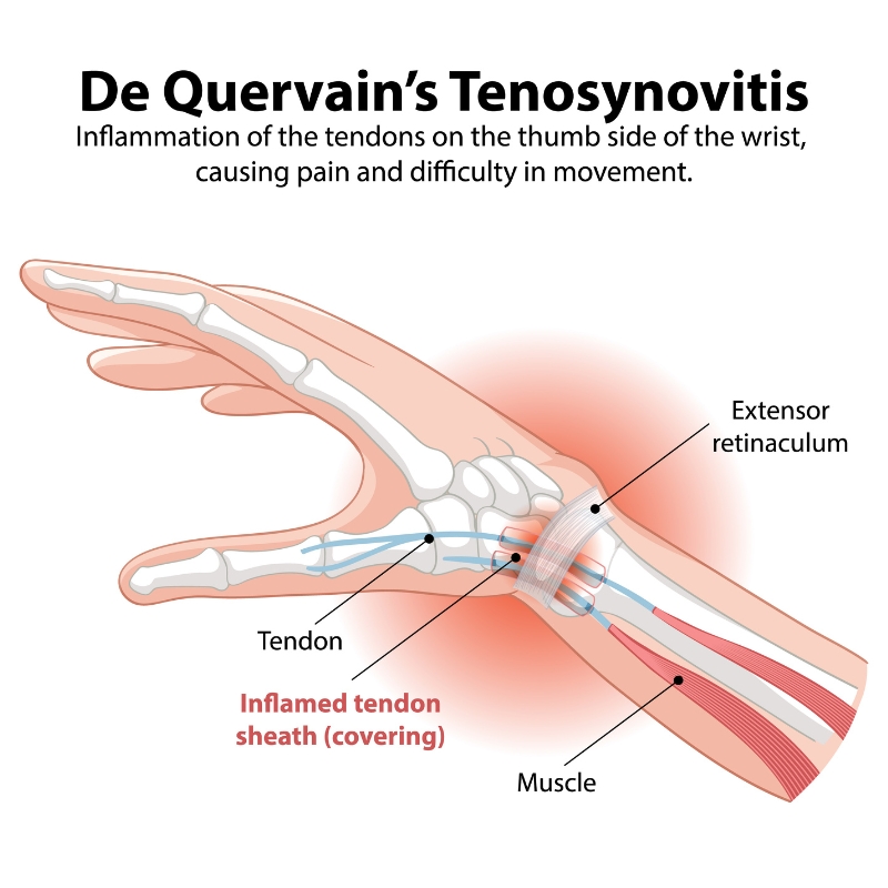 Tenosinovitis de De Quervain