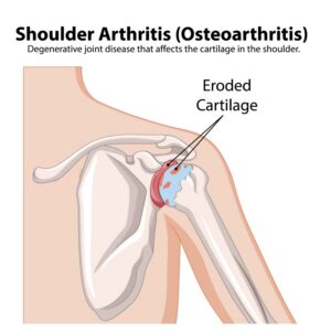 Artritis de hombro
