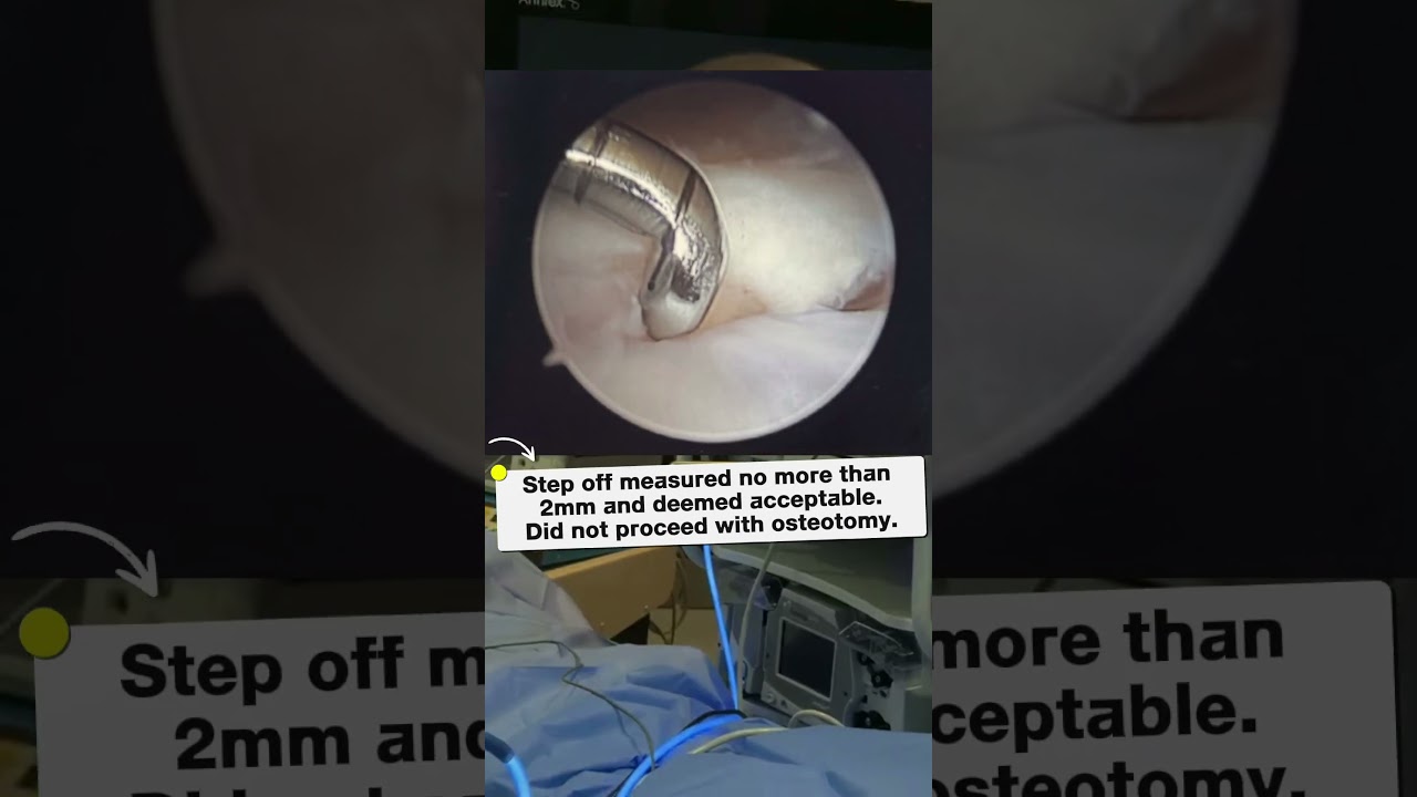 Resumen de #LiveSurgeryTuesday: Artroscopia de muñeca con posible osteotomía abierta por consolidación viciosa del radio distal