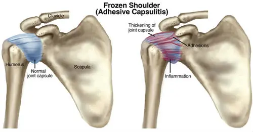 frozen shoulder anatomy