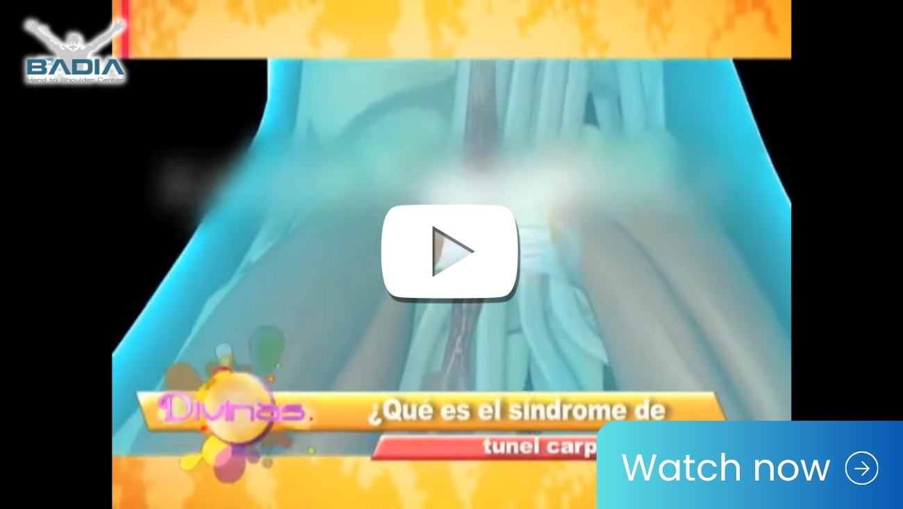 ¿Que es el síndrome de Túnel Carpiano?