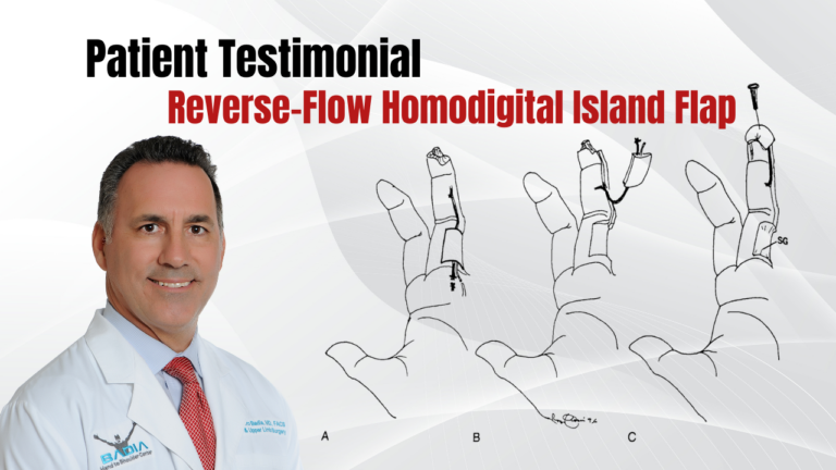 Patient Testimonial Homodigital Island Flap by Dr. Badia