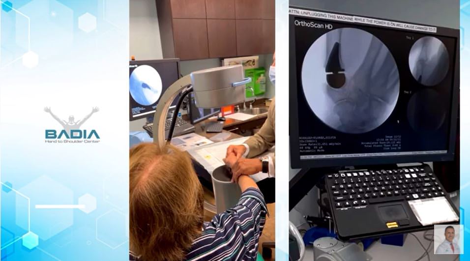 Osteoartritis avanzada de la articulacion del pulgar