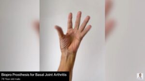 Prótesis BioPro para la artritis de la articulación basal