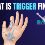What is Trigger finger?