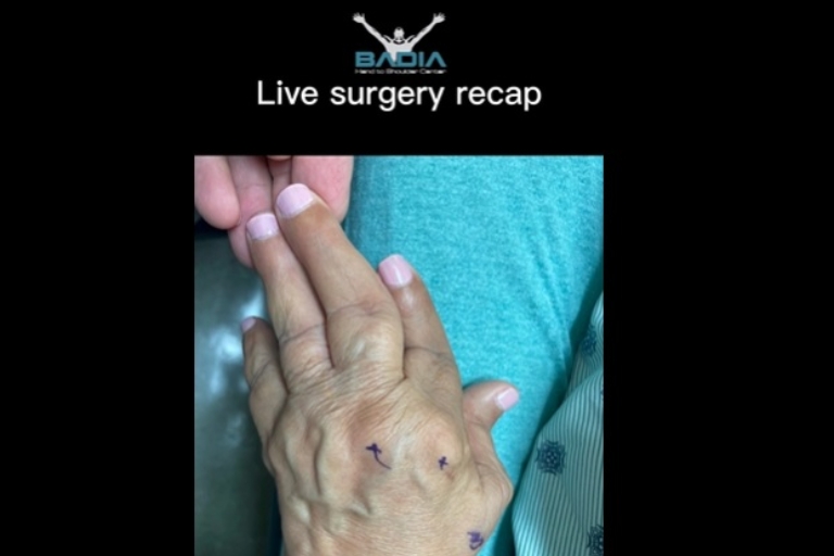Rheumatoid Arthritis Patient Traveled From The Dominican Rep. To Regain Function In Her Fingers!