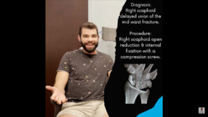 Patient visits OrthoNOW & discovers he has a scaphoid fracture that never healed.