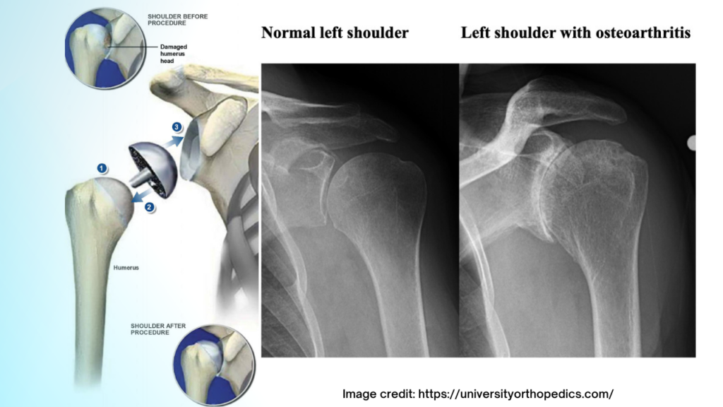 shoulder resurfacing.osteoarthritis