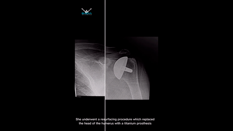 This patient had bilateral shoulder replacements (shoulder resurfacing)
