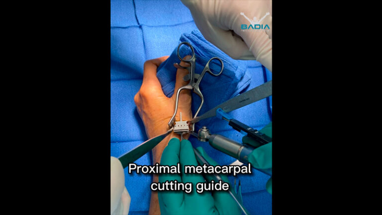 Patient Flew In From Texas Looking For A Solution For Basal Joint Arthritis.