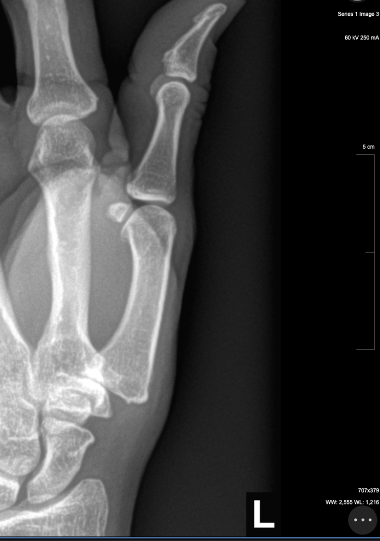 radiografía de la artritis de la articulación basal