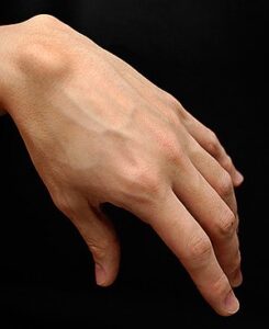 Dorsal Wrist Ganglia