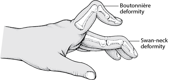 swan neck deformity in the finger