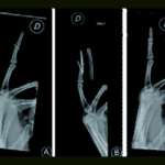 mallet finger fracture xray